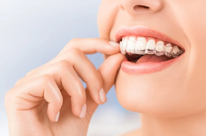 Invisalign: A Contemporary Revolution In Orthodontics For Straighter Smiles