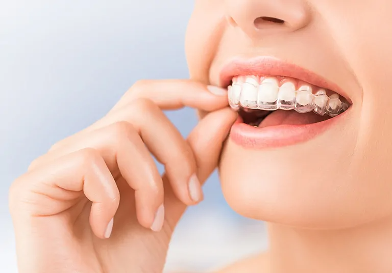 Invisalign: A Contemporary Revolution In Orthodontics For Straighter Smiles